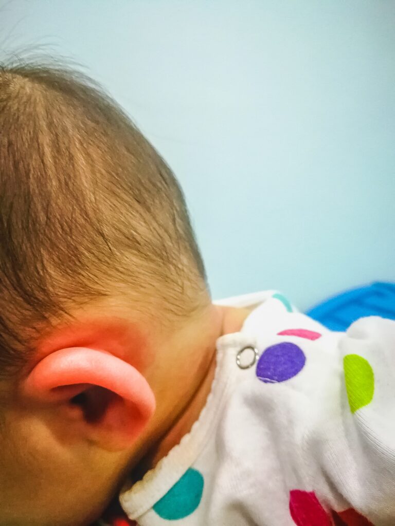 Baby ear with skin allergy on the face. senawang